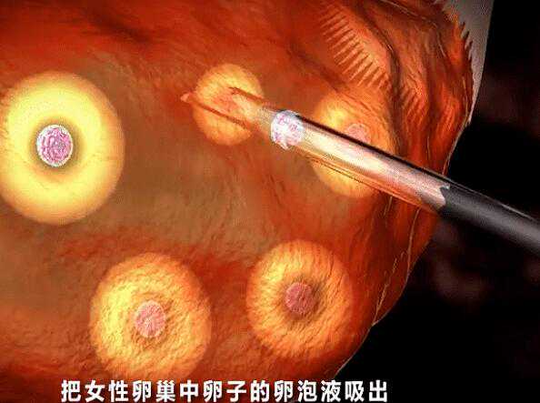 供卵代怀孕，柳州工人医院和人民医院哪个好(太和人民医院和阜阳人民医院哪个好)